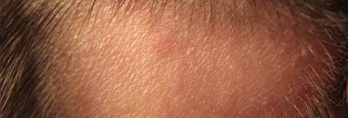 Alopecia gracias a Creamaster de Flickr.com Alopecia gracias a Creamaster de Flickr.com